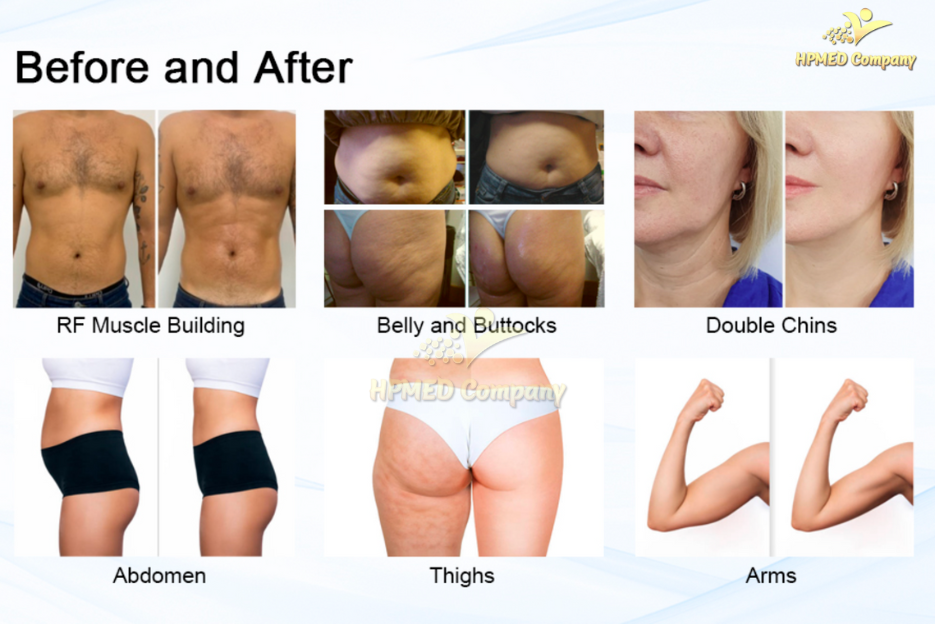 Tại sao nam giới nên triệt lông vùng kín?