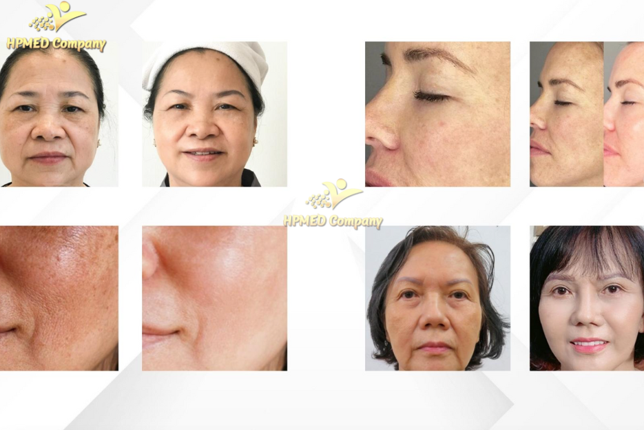 Quá trình quang cơ chọn lọc của Laser ND:YAG hoạt động như thế nào? 3 23