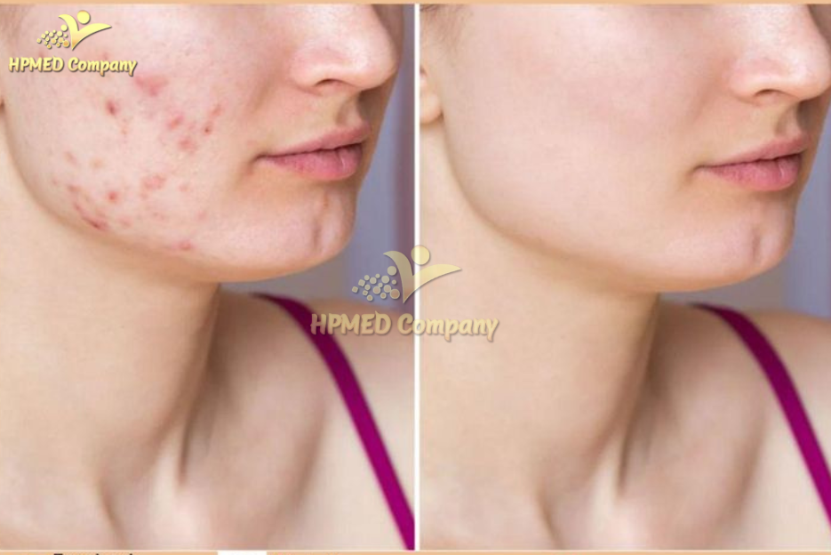 Máy xóa nhăn Công nghệ RF