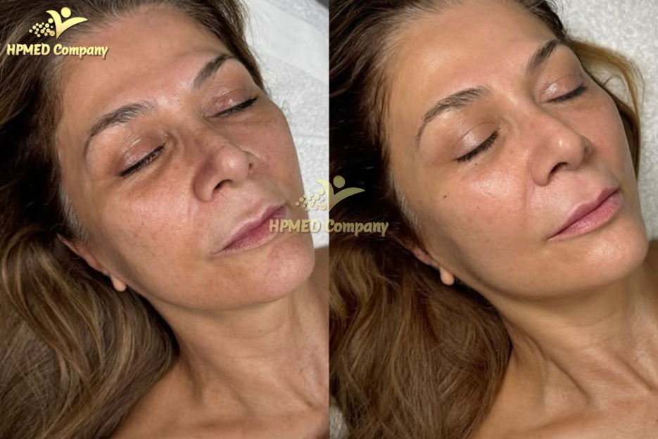 Đối tượng phù hợp sử dụng máy trẻ hóa da HIFU