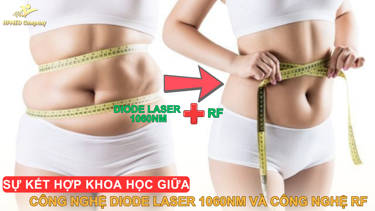 Sự kết hợp khoa học giữa công nghệ giảm béo Diode Laser 1060nm và Công nghệ giảm béo RF 1 Sự kết hợp khoa học giữa công nghệ giảm béo Diode Laser 1060nm và Công nghệ giảm béo RF