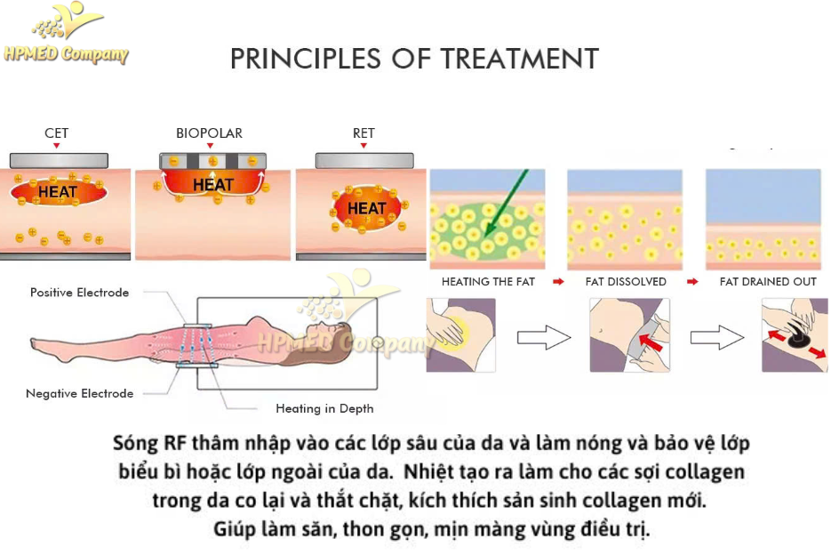 Sự kết hợp khoa học giữa công nghệ giảm béo Diode Laser 1060nm và Công nghệ giảm béo RF 3 RF