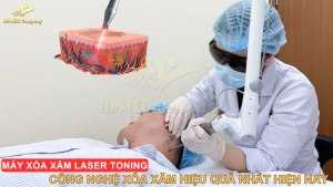 Máy Xóa Xăm Laser Toning – Công Nghệ Xóa Xăm Hiệu Quả Nhất Hiện Nay 2025