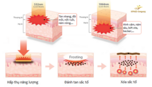Giới Thiệu Công Nghệ Điều Trị Sắc Tố Laser ND YAG Q-Switched