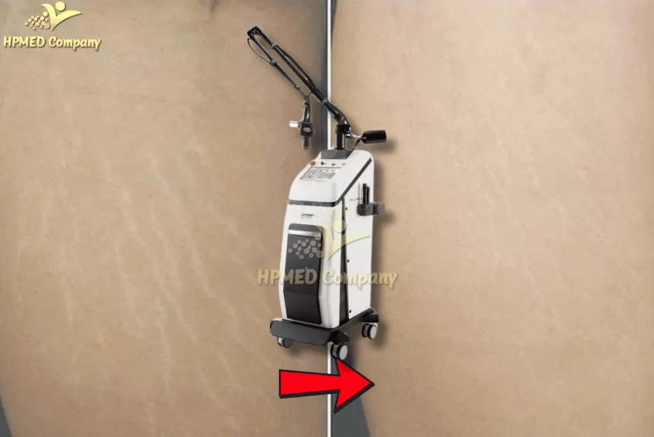 Laser CO2 Fractional Trị Rạn Da Laser CO2 Fractional Trị Rạn Da