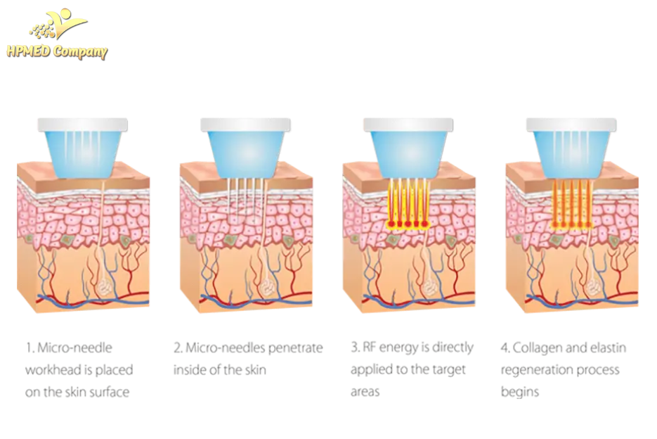 Công nghệ RF (Radio Frequency) Fractional Công nghệ RF (Radio Frequency) Fractional