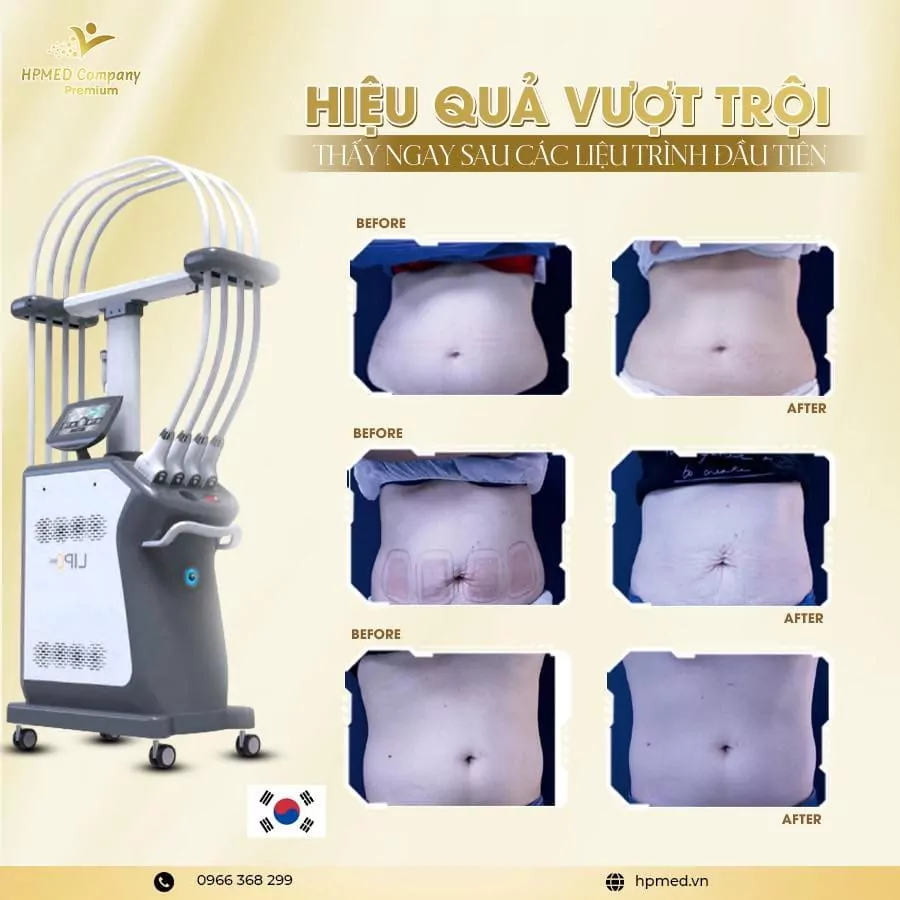 Máy Giảm Béo Diode Laser 1060 Lipo Cao Câp Hàn Quốc