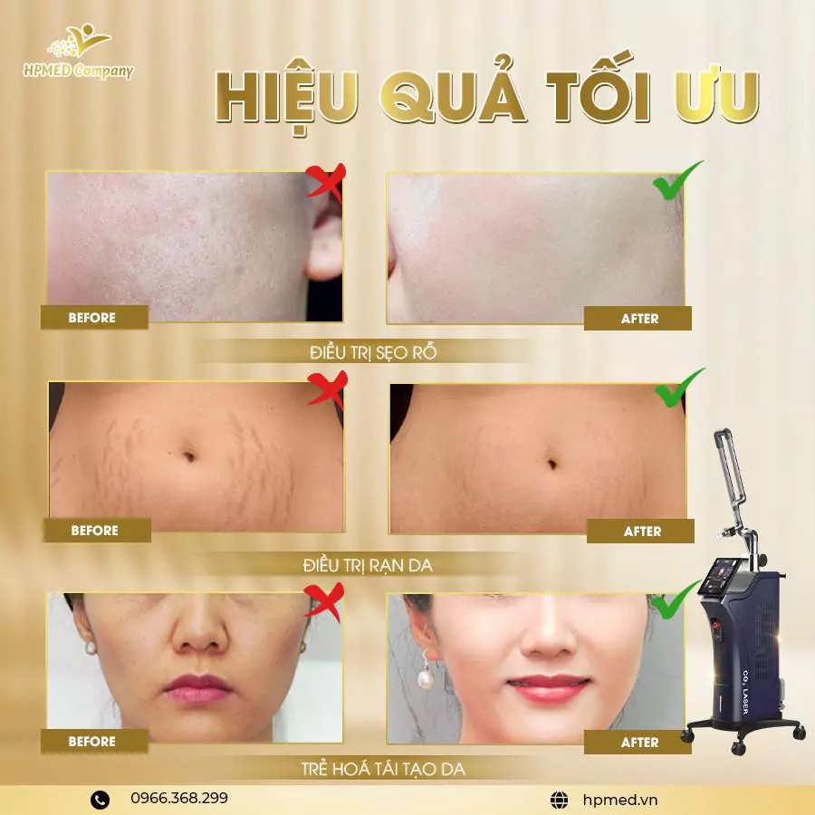 Công dụng Máy Laser Co2 Fractional Harmoni RF