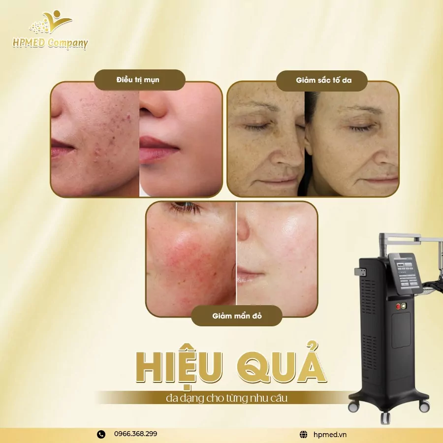 Máy Ánh Sáng Sinh Học PDT ADSS – Giải Pháp Chăm Sóc Da Công Nghệ LED Đa Bước Sóng