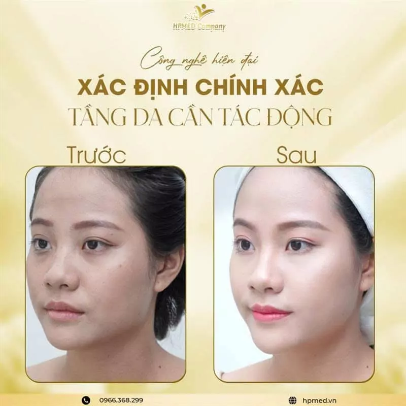 Máy Hifu Nâng Cơ Cao Cấp HPmed