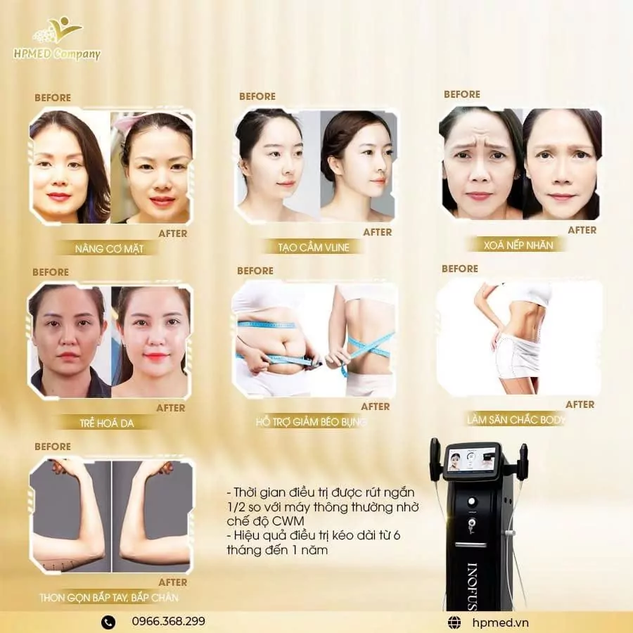 Ứng Dụng Máy HIFU Nâng Cơ Inofus Cao Cấp Hàn Quốc