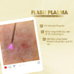 Máy Plasma Cold ✨ Công Nghệ Plasma Lạnh Chăm Sóc Da Chuyên Sâu