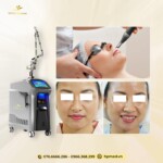 Máy Laser ND YAG Q-Switch SL-NY 602 | Bắc Kinh