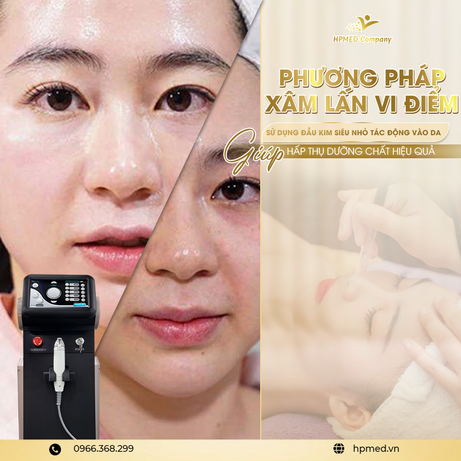 Máy rf vi điểm pinacle - 06