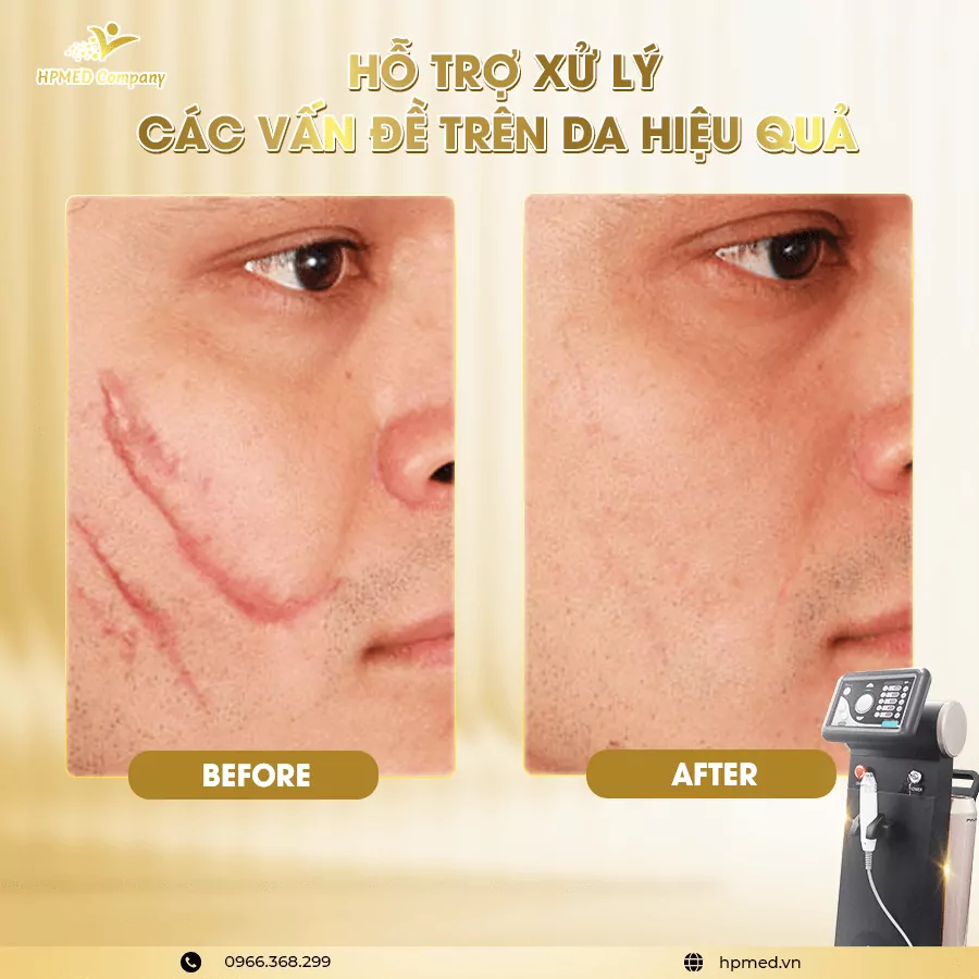 Máy Rf Vi Điểm Pinacle Cao Cấp Hàn Quốc