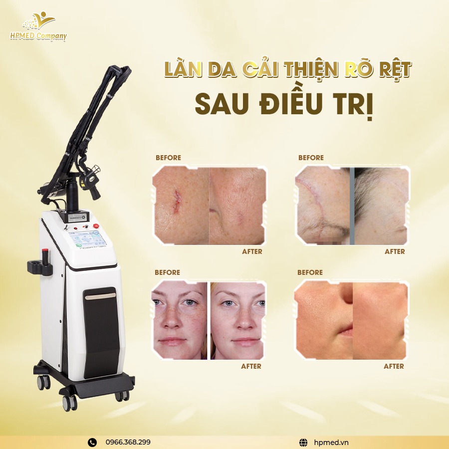 Máy Laser CO2 Fractional Pentagon GRAND Bóng Hợp Kim RF ⭐ Chuẩn Trị Sẹo &amp; Tái Tạo Da Chuyên Sâu Hàn Quốc