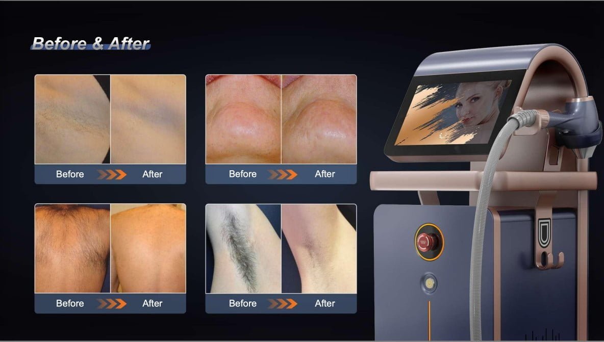 Máy Triệt Lông Diode Laser 1800 HIDL