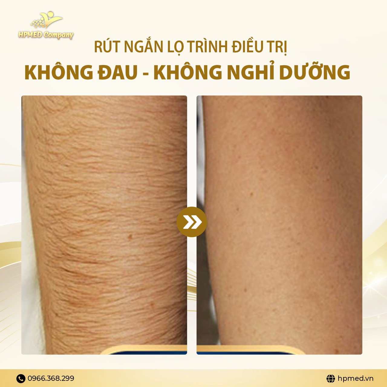 Máy Triệt Lông DPL SPECTRUM - 09