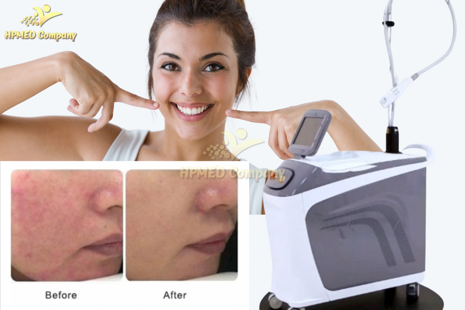 Ứng Dụng Của Laser Xung Dài Long Pulse 1064nm