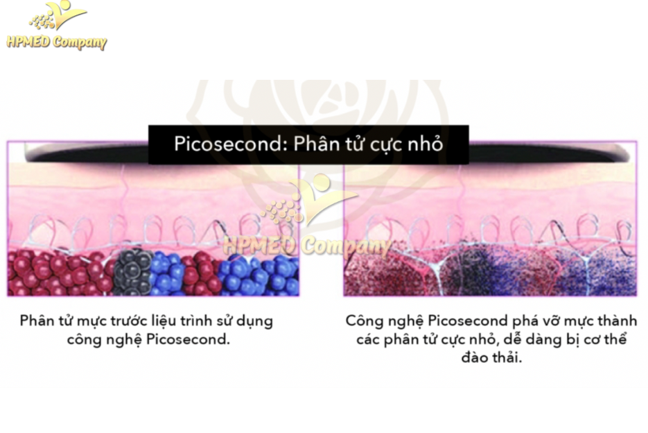 So sánh hiệu ứng Quang nhiệt và Quang cơ của Laser Nanosecond và Picosecond 3 Laser Picosecond (PicoSure, PicoWay)