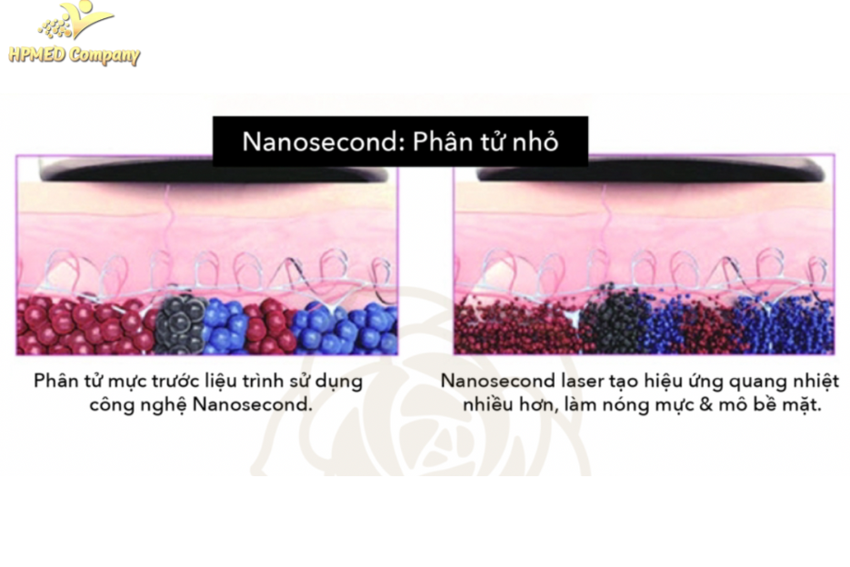 So sánh hiệu ứng Quang nhiệt và Quang cơ của Laser Nanosecond và Picosecond 2 Laser Nanosecond (Q-Switched ND:YAG)