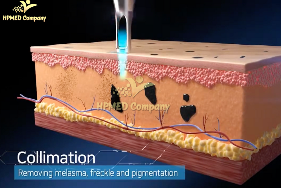 Quang cơ, trị nám, laser
