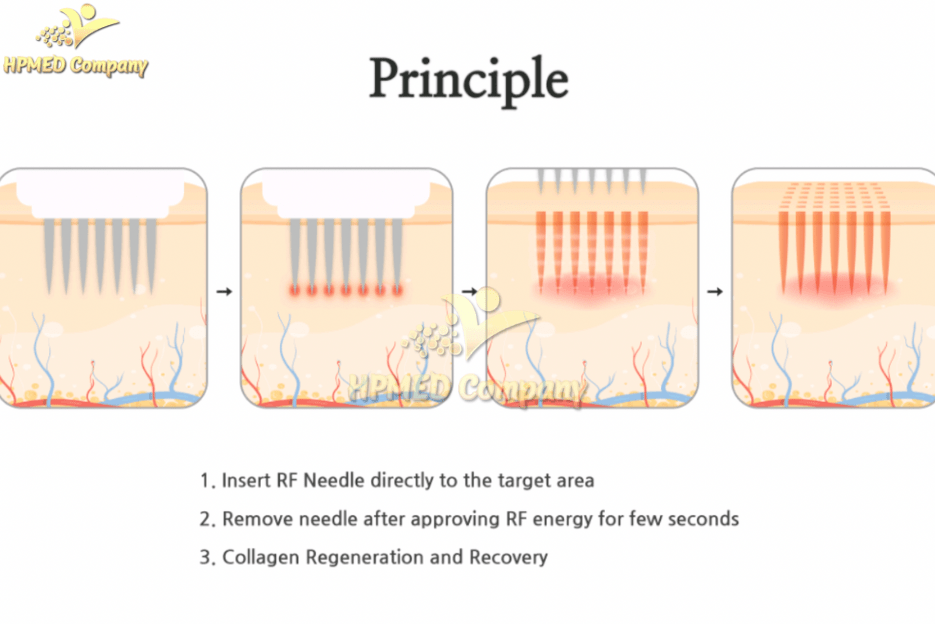 Công Nghệ RF Vi Điểm Fractional – Bước Tiến Vượt Bậc Trong Trẻ Hóa Da 2 Máy RF Vi Điểm