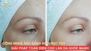 Công Nghệ Ánh Sáng Sinh Học PDT – Giải Pháp Toàn Diện Cho Làn Da Khỏe Mạnh
