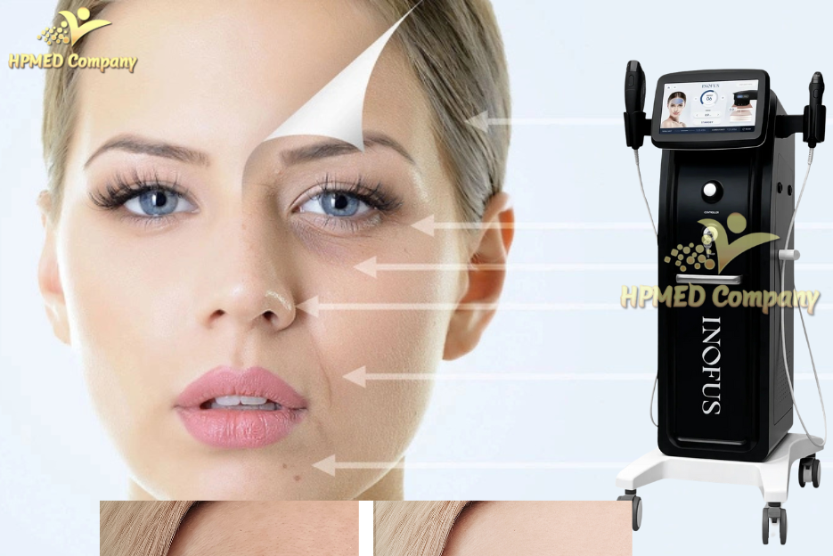 Công Nghệ HIFU Sóng Siêu Âm Hội Tụ – Giải Pháp Nâng Cơ Trẻ Hóa Hàng Đầu 5 Công nghệ HIFU