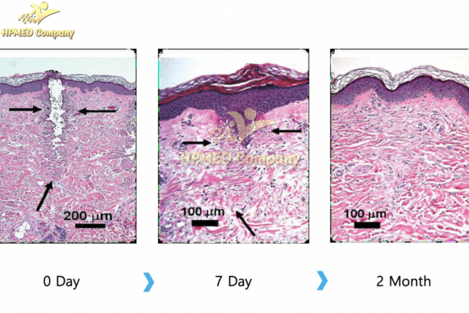 Công Nghệ RF Vi Điểm Fractional – Bước Tiến Vượt Bậc Trong Trẻ Hóa Da 4 6