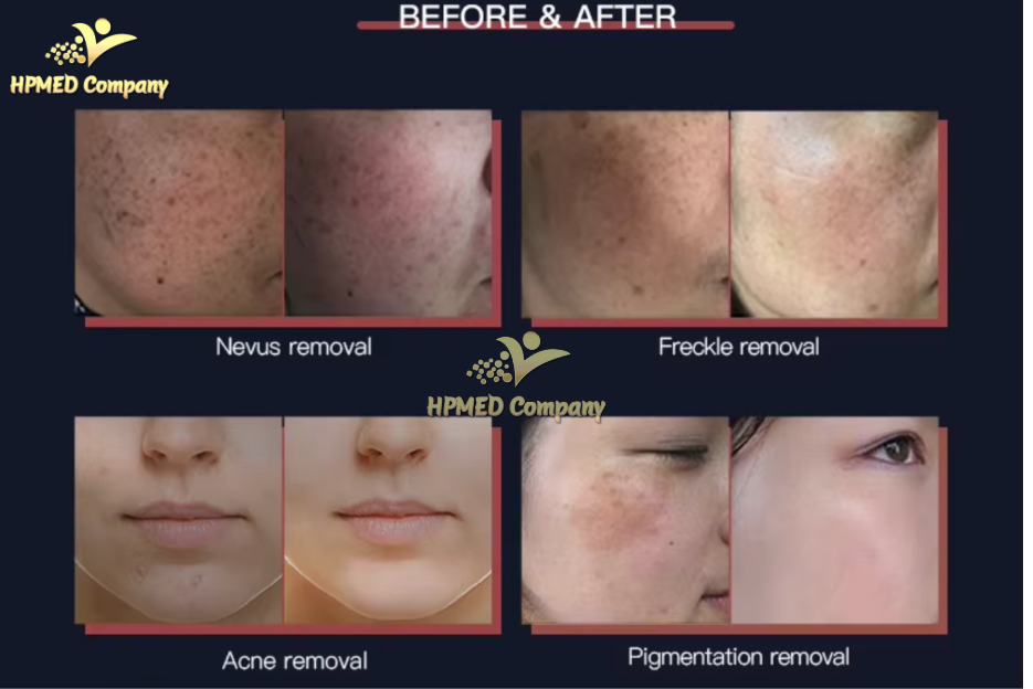 Ai Nên Và Không Nên Sử Dụng Máy Laser YAG?