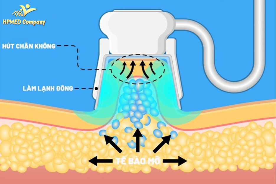 mỡ nội tạng và mỡ dưới da là gì ? nguyên nhân hình thành và cách giảm mỡ nội tạng và mỡ dưới da 5 Công nghệ Cryolipolysis – Đông hủy mỡ bằng nhiệt lạnh