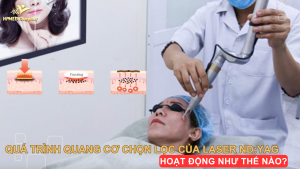 Quá trình quang cơ chọn lọc của Laser ND:YAG hoạt động như thế nào?