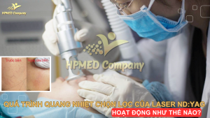 Quá trình quang nhiệt chọn lọc của laser ND:YAG hoạt động như thế nào?