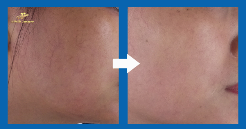 May triet long tai nha 5 9