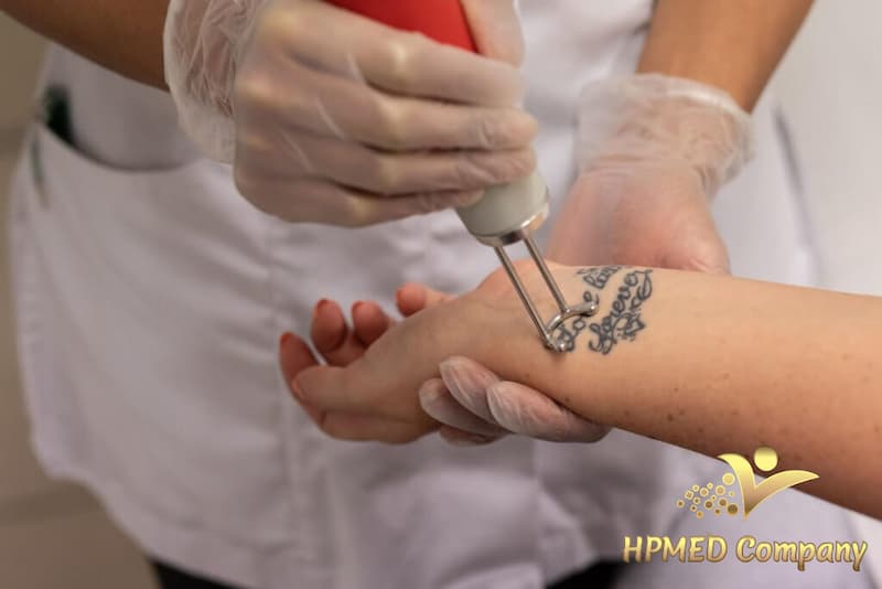 cách sử dụng máy laser xoá xăm Ví dụ về cách sử dụng máy laser xoá xăm