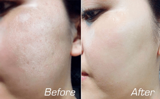 Công Nghệ RF Vi Điểm Fractional – Bước Tiến Vượt Bậc Trong Trẻ Hóa Da 3 điều trị sẹo bằng máy rf vi điểm