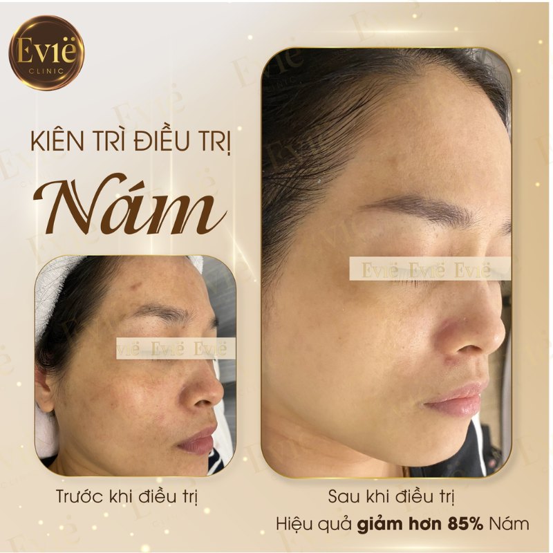 Spa trị nám ? Top 5 Lợi ích khi trị nám tại spa 3 Spa trị nám ? Top 5 Lợi ích khi trị nám tại spa