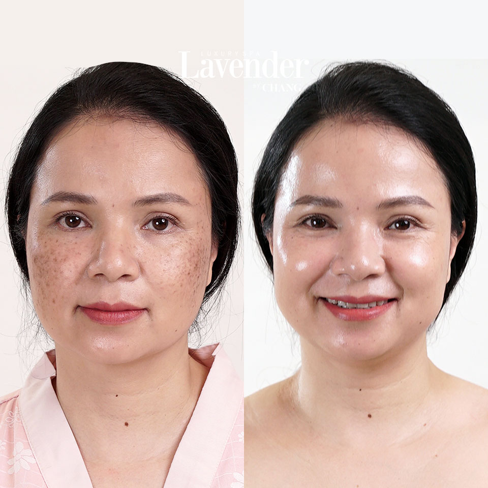 Spa trị nám ? Top 5 Lợi ích khi trị nám tại spa 1 Spa trị nám ? Top 5 Lợi ích khi trị nám tại spa