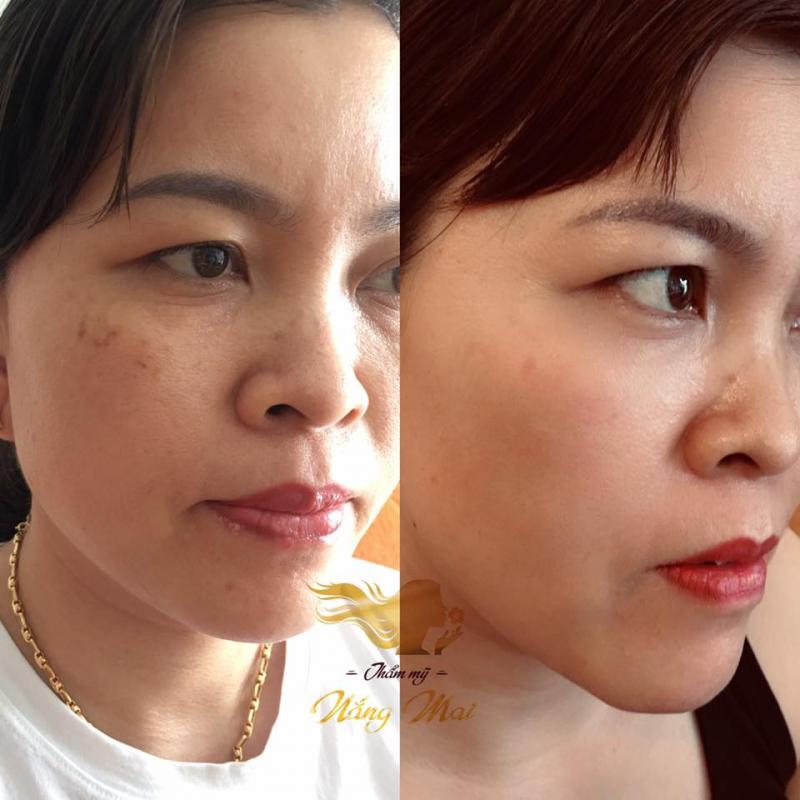 Spa trị nám ? Top 5 Lợi ích khi trị nám tại spa 5 Spa trị nám ? Top 5 Lợi ích khi trị nám tại spa