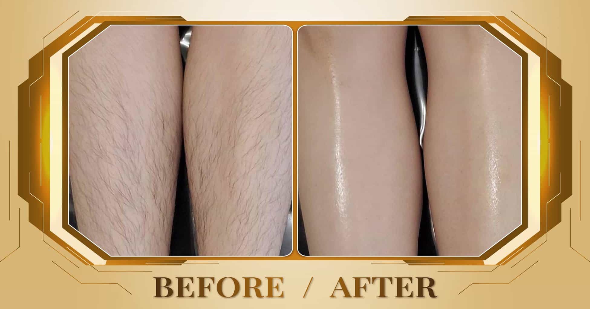 triệt lông chân có các phương pháp gì ? chi phí triệt lông chân ?