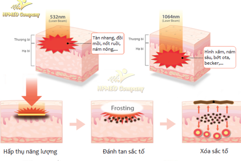 Đầu Tư Để Nhanh Thu Hồi Vốn: Nên Chọn Laser CO2 Fractional Hay Laser Nd YAG Trước? 3 Laser Nd:YAG Q-Switched