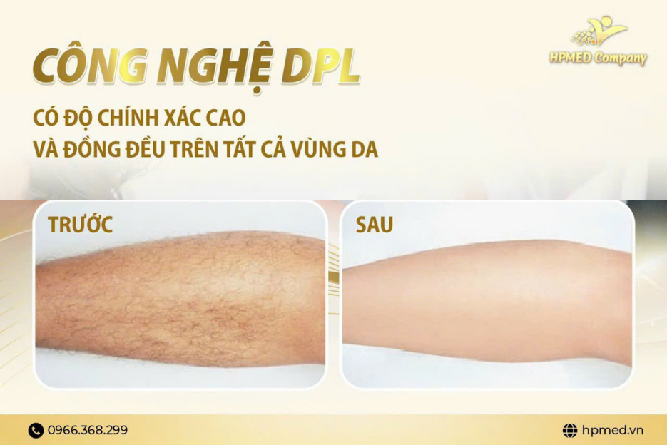 Hiệu Quả Của Máy Triệt Lông IPL