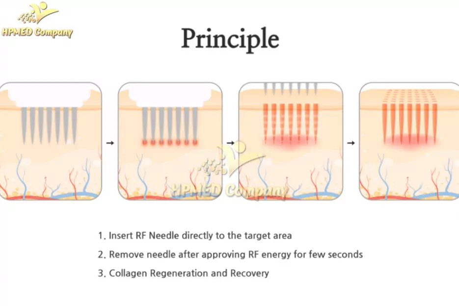 Nguyên Lý Hoạt Động Máy RF Vi Điểm