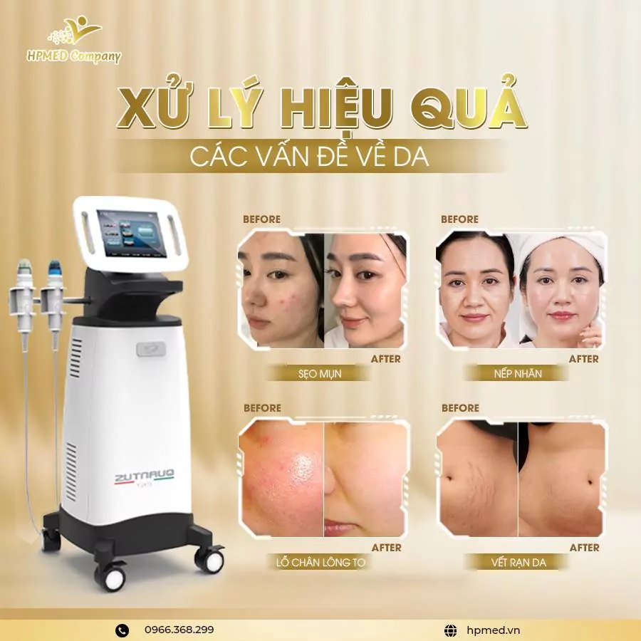 Máy Trị Sẹo Rf Vi Điểm Quantus Bắc Kinh