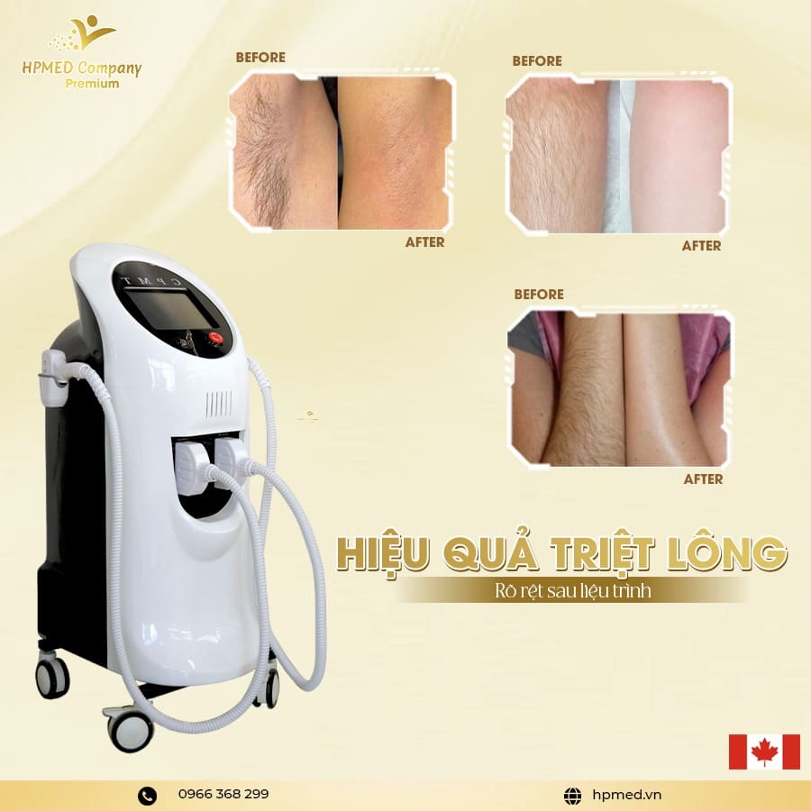 Máy Triệt Lông Diode Laser Cao Cấp