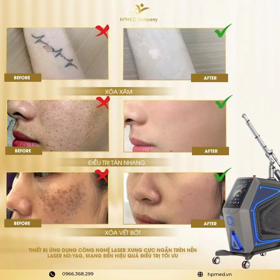 Máy Xóa Xăm Laser Pico Med860