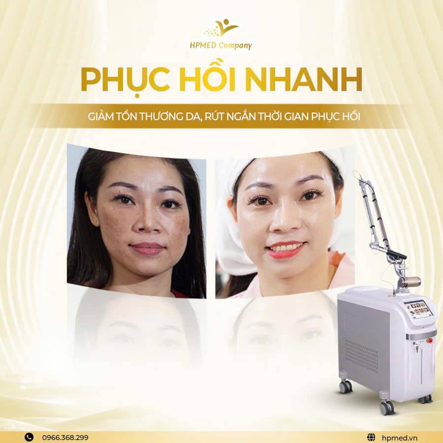 Máy Xóa Xăm Laser Pico Ultra 360