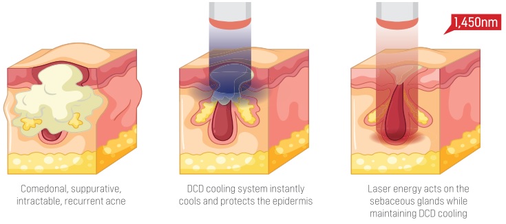 Máy Laser Noable Laser 1450nm Triệt Dầu Trị Mụn - 02