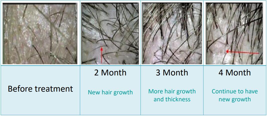 máy mọc tóc, máy điều trị rụng tóc bằng laser